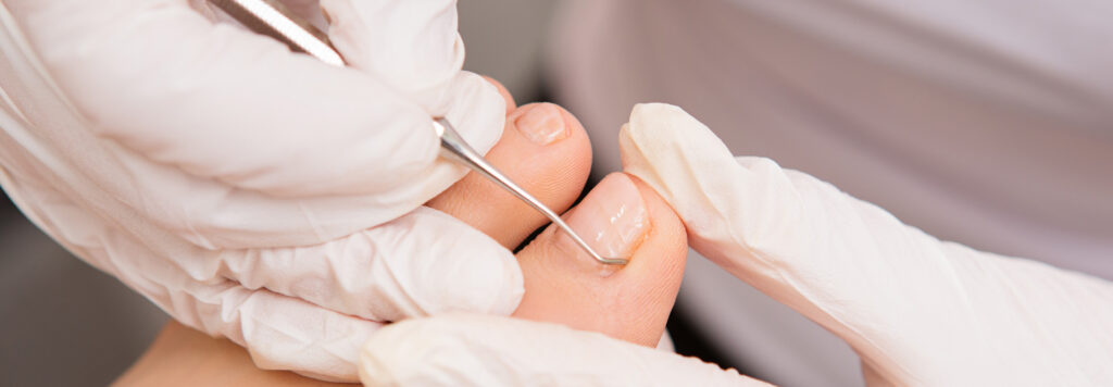 Zabieg na wrastające paznokcie Toruń w gabinecie podologicznym