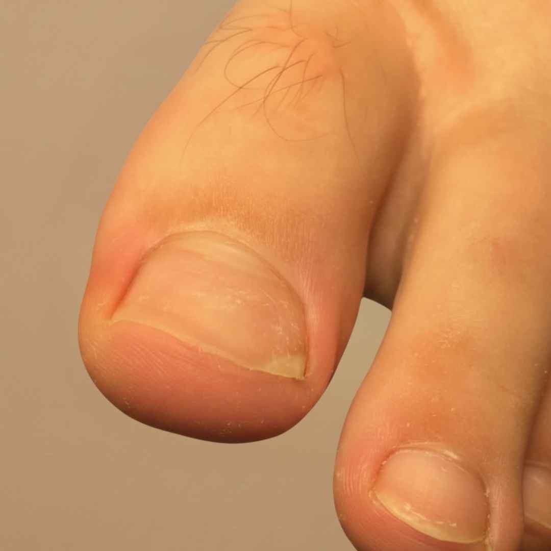 Duży palec u stopy z pogrubioną, zażółconą i lekko zakrzywioną płytką paznokcia