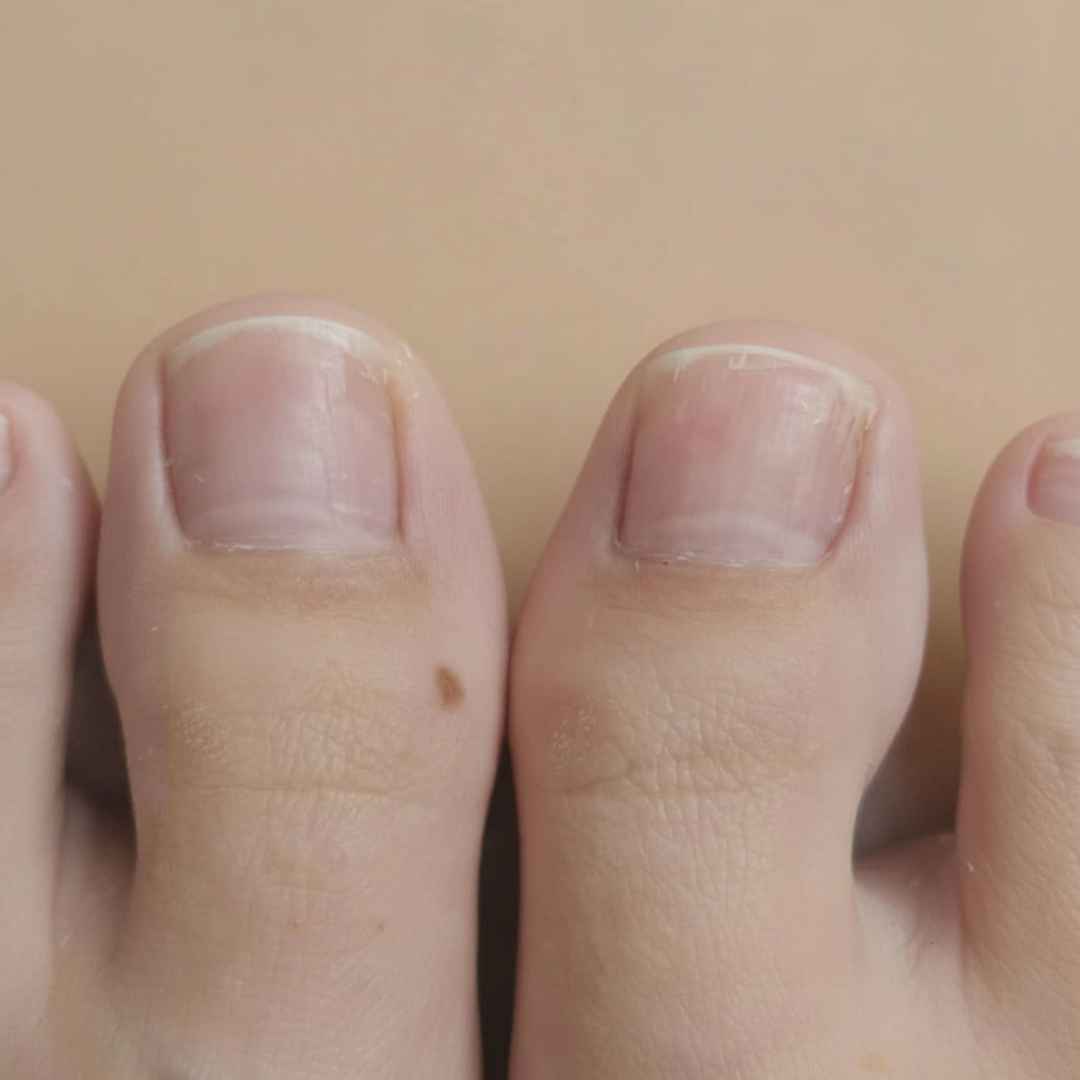 Dwa duże palce u stóp ze zdrową, jasną płytką paznokcia i prawidłowym kształtem