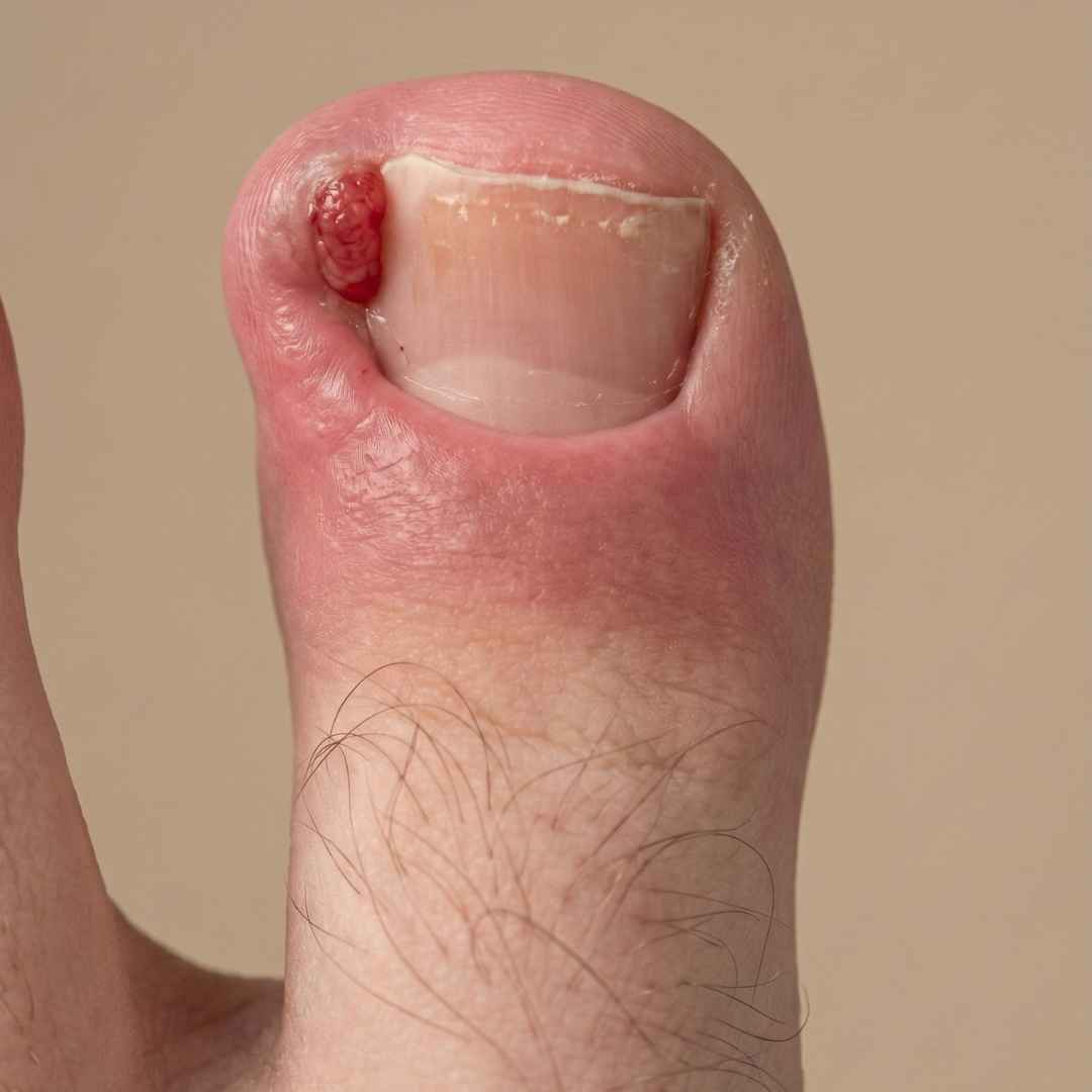 Wrastający paznokieć z silnym stanem zapalnym, obrzękiem i zaczerwienieniem wału okołopaznokciowego