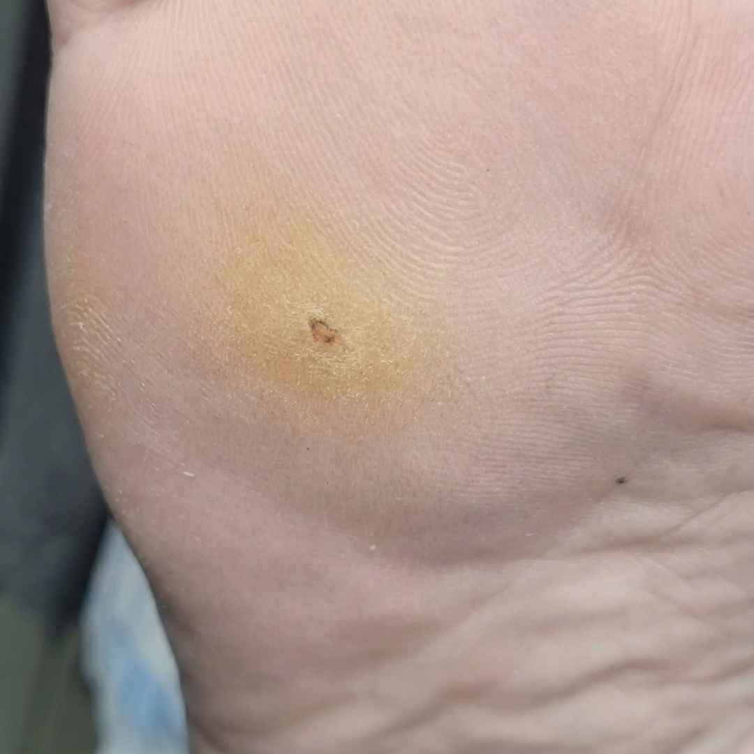 Specjalista wykonuje usuwanie brodawek wirusowych preparatem Verru Shot w gabinecie Zdrowe Stopy.